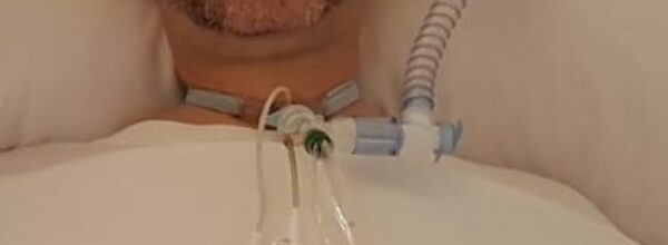 Il 21 giugno è la Giornata Mondiale della Sla ( Sclerosi Laterale Amiotrofica (SLA), conosciuta anche come “Morbo di Lou Gehrig”, “malattia di Charcot” o “malattia del motoneurone”